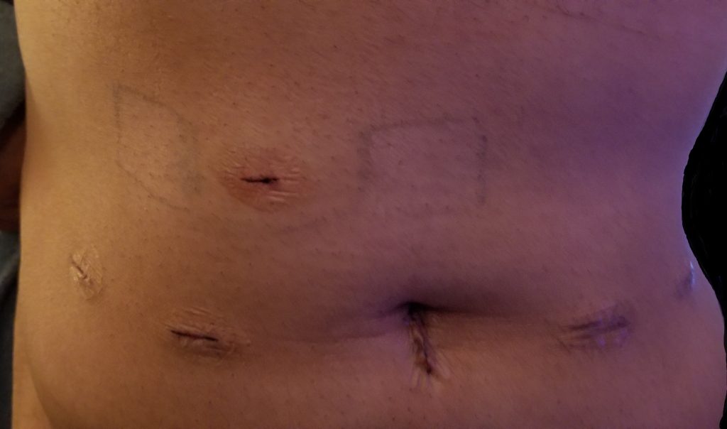 My abdomen after surgery